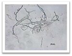 Ветвистый мицелий в соскобе с ногтей при онихомикозе (Tr.rubrum в посеве, подтвержден ПЦР)