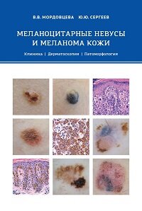 Меланоцитарные невусы и меланома кожи
