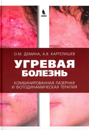 Угревая болезнь. Комбинированная лазерная и фотодинамическая терапия