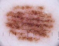 Reticular_pattern_.JPG
